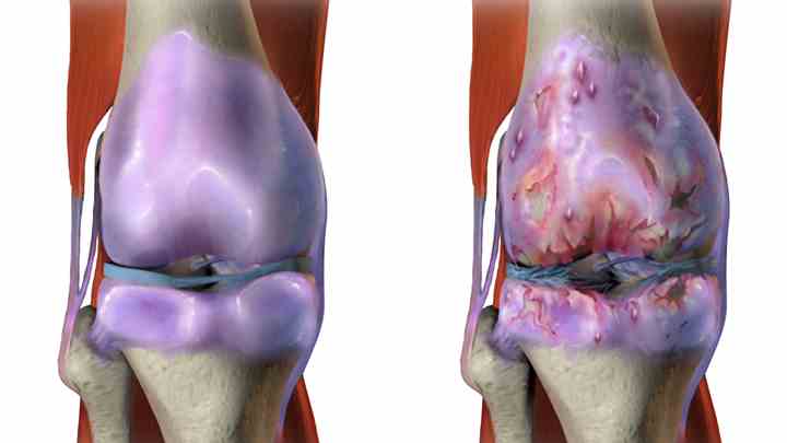 natural remedies for osteoarthritis