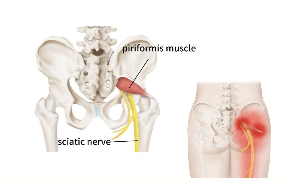 Dealing with Piriformis Syndrome